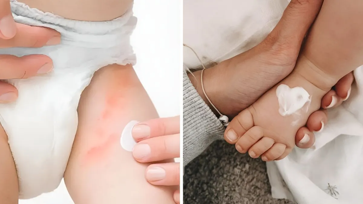 Due to the consent wearing of a diaper, newborn babies may have rashes ...